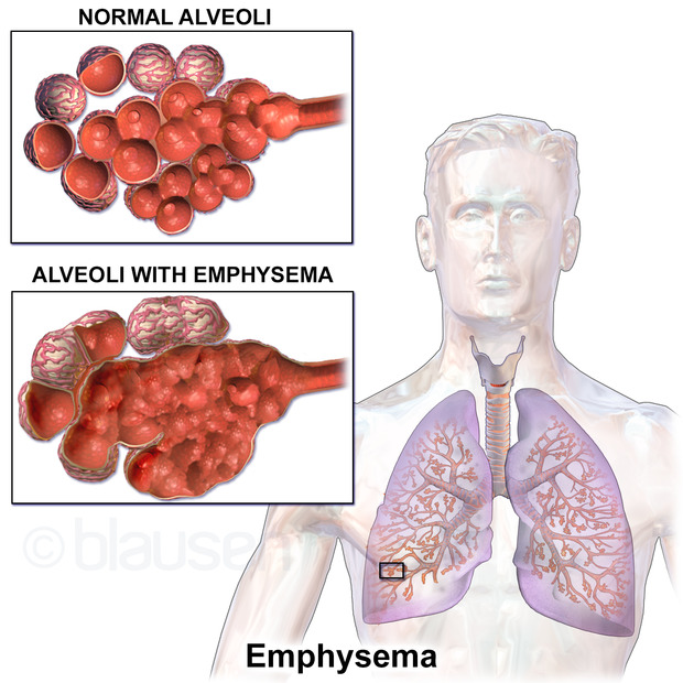 a diagram of normal alveoli vs alveoli affected by emphysema