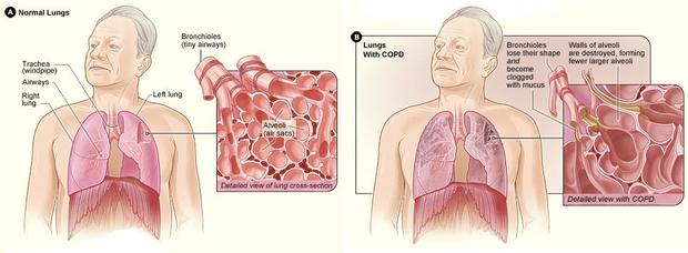 diagram of how COPD affects the lungs