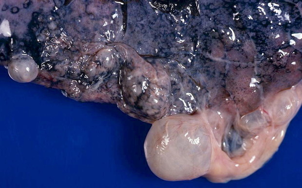 a lung affected by bullous emphysema