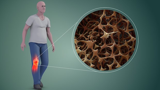 a diagram of porous bone in a man